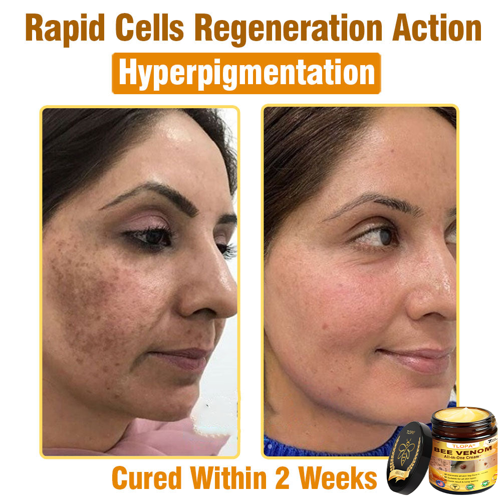 TLOPA® Bee Venom All-in-One Cream US Dermatologist Approved