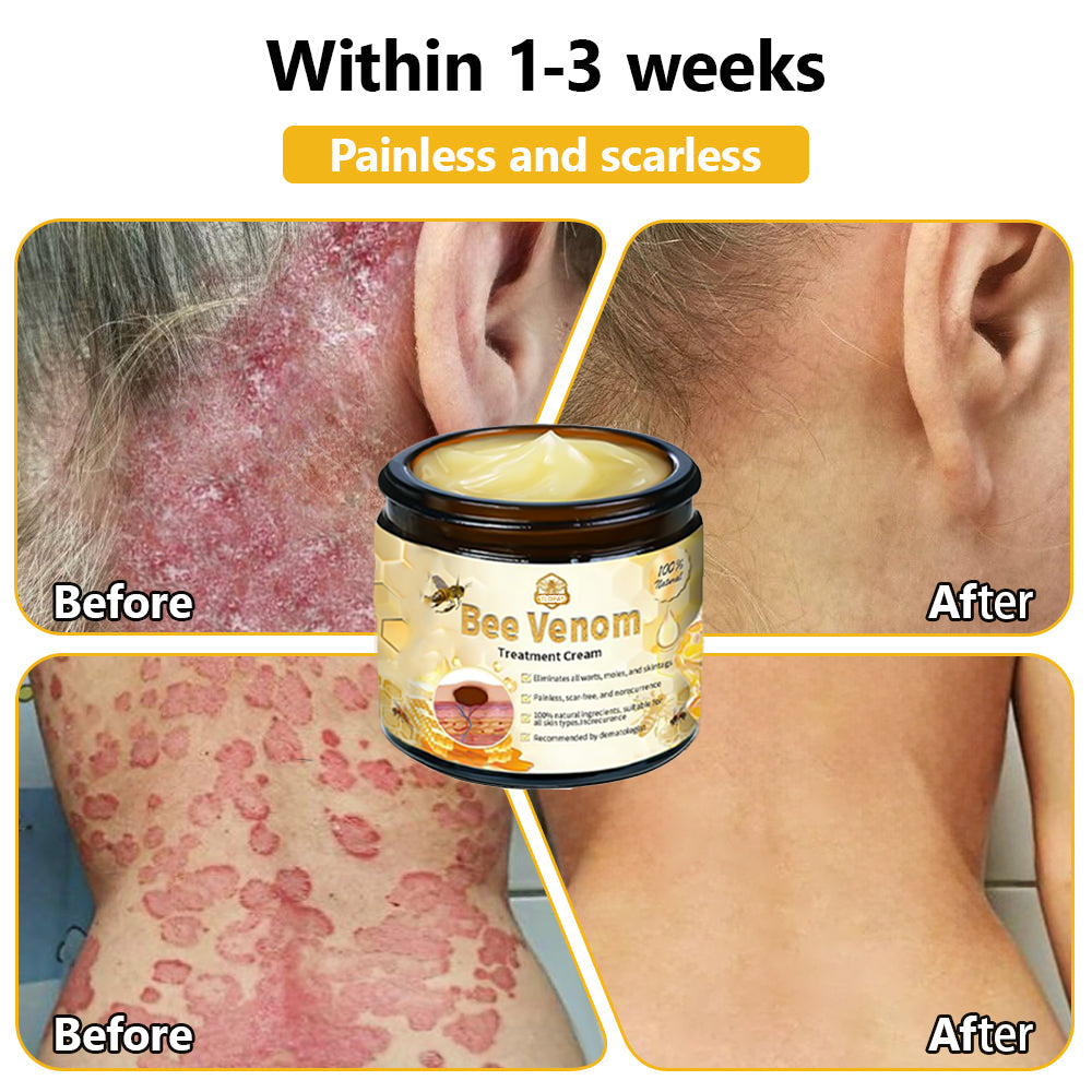 Skin tested certification | 𝙏𝙇𝙊𝙋𝘼™ Bee Venom Skin Treatment Cream (AAD Recommended) (Up to 70% off)