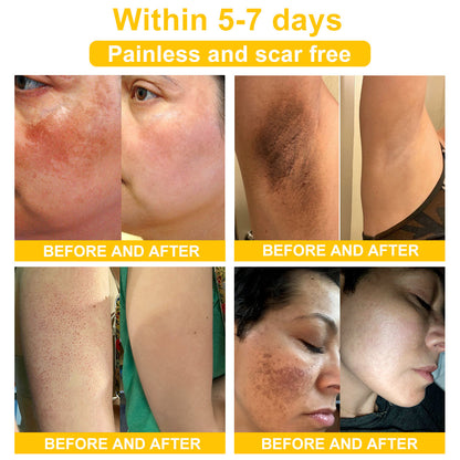 TLOPA® Bee Venom Skin Cream（👨‍⚕AAD Recommended),for Remove Warts, Acne and Scars ✅