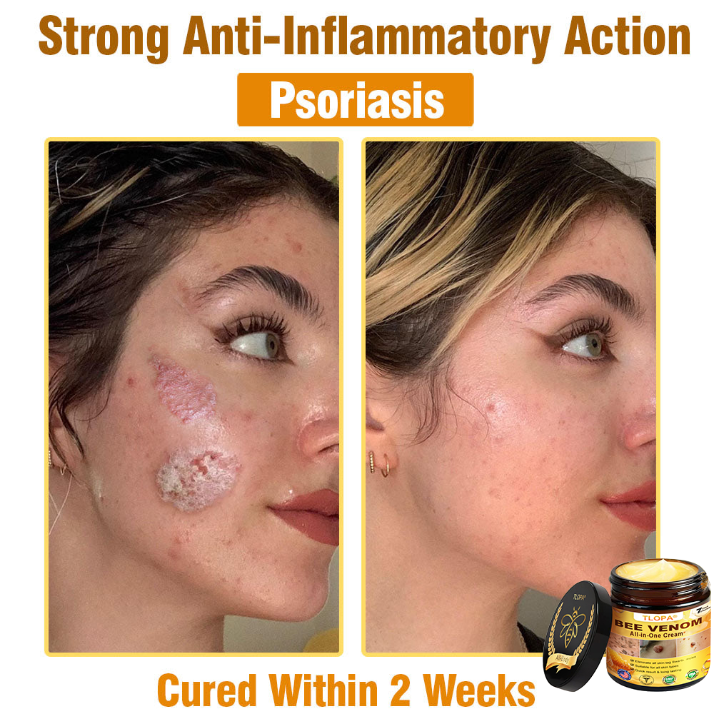 TLOPA® Bee Venom All-in-One Cream US Dermatologist Approved