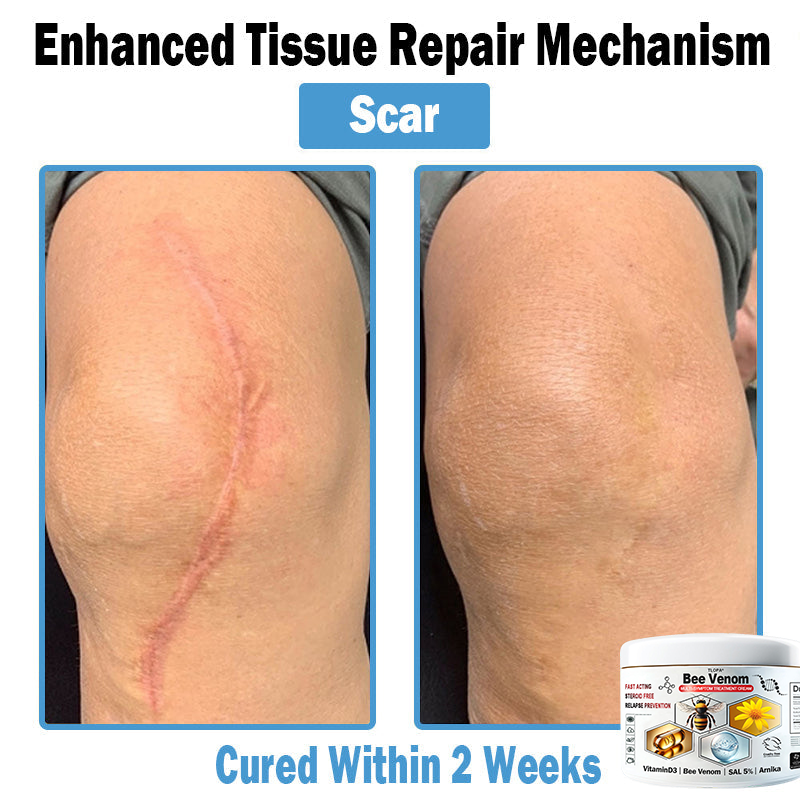 TLOPA® Bee Venom Multi-Symptom Skin Treatment Cream (👨‍⚕🌟Extra 30% off on sale items!