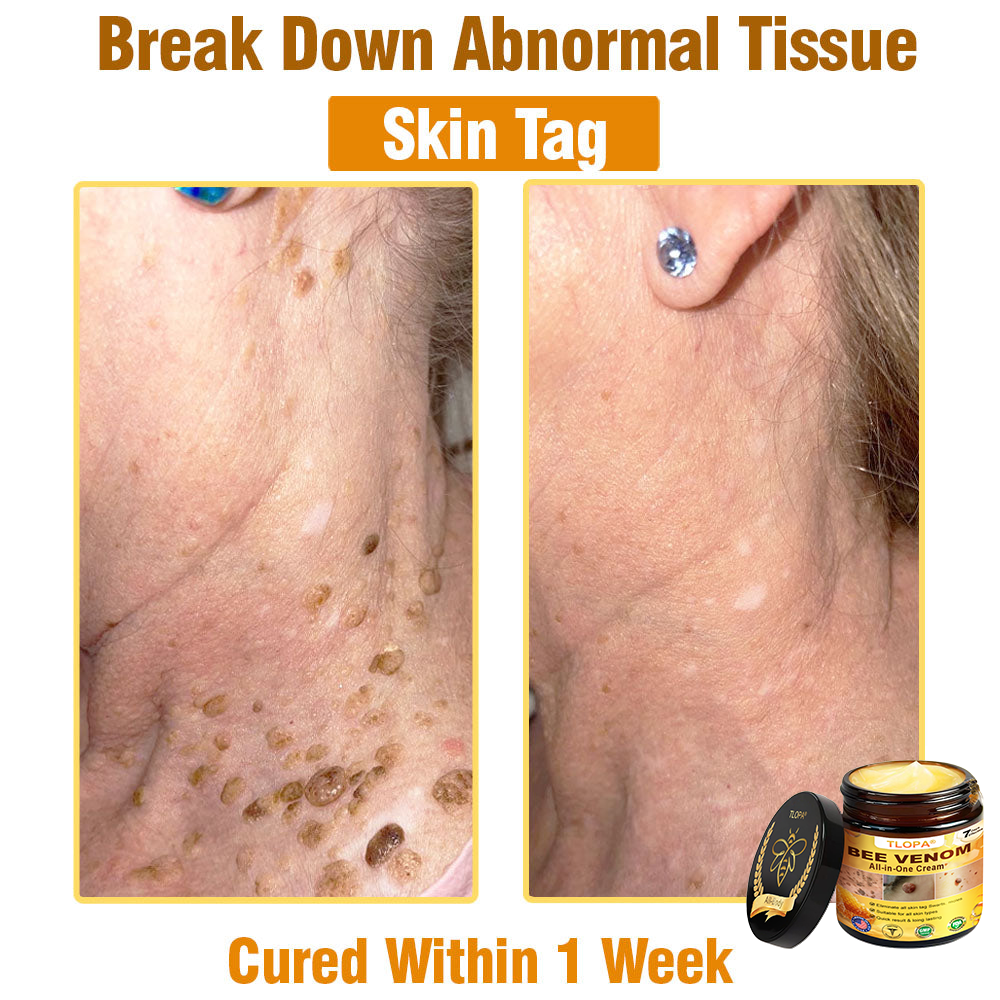 TLOPA® Bee Venom All-in-One Cream US Dermatologist Approved
