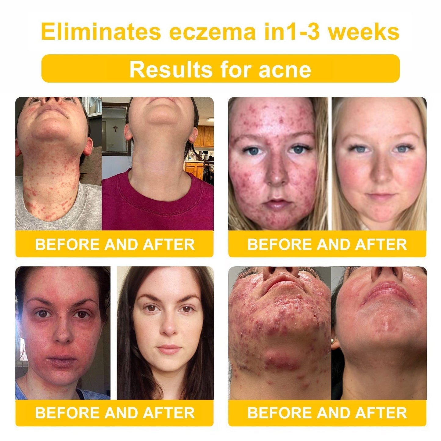 TLOPA® Bee Venom Skin Cream（👨‍⚕AAD Recommended),for Remove Warts, Acne and Scars ✅