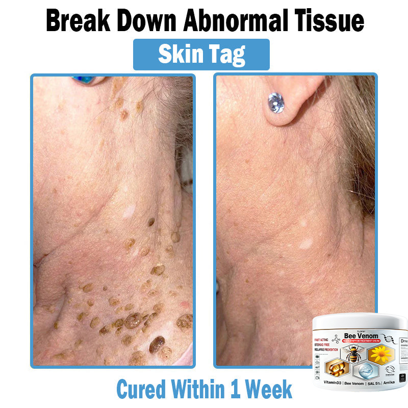 TLOPA® Bee Venom Multi-Symptom Skin Treatment Cream (👨‍⚕🌟Extra 30% off on sale items!