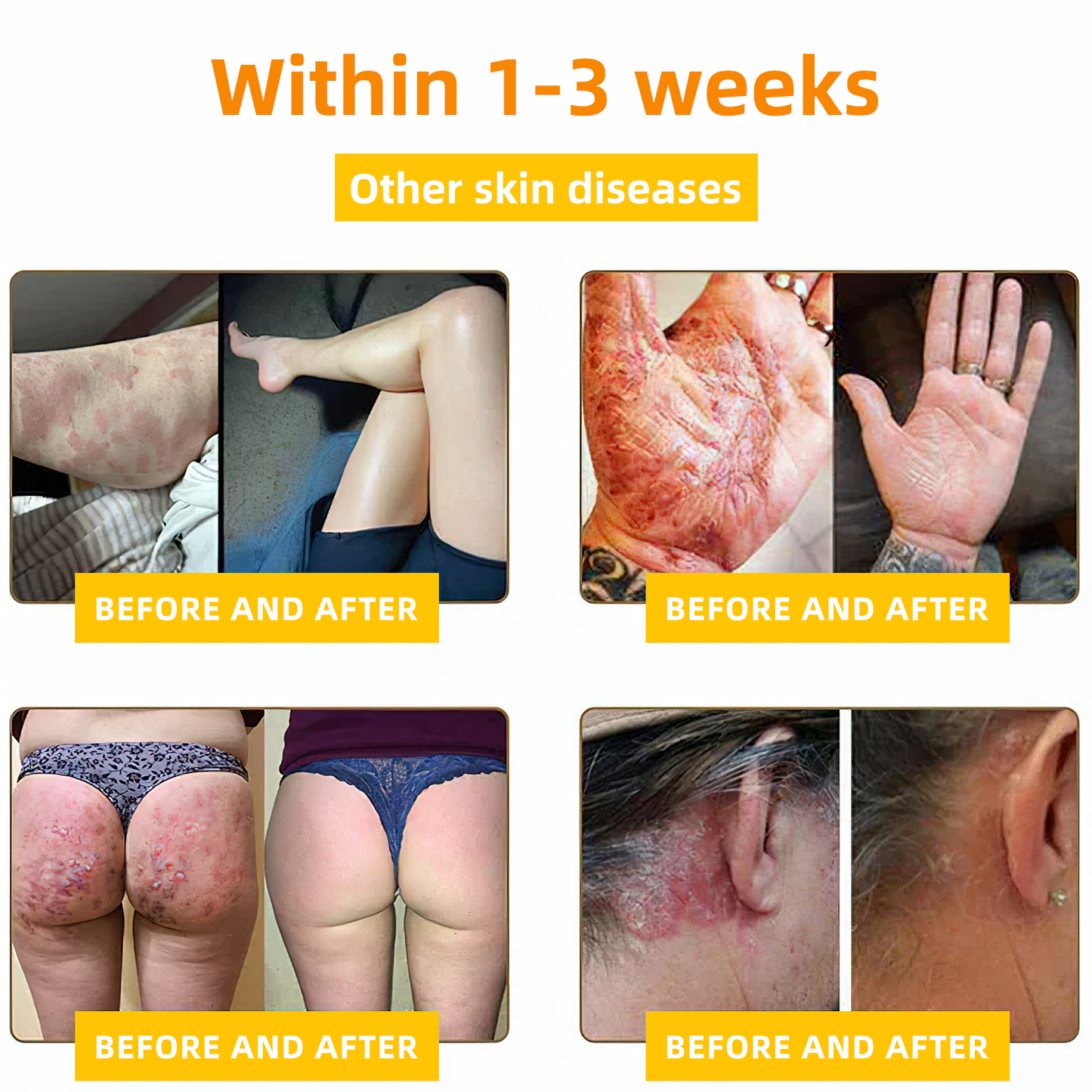 TLOPA® Bee Venom Skin Cream（👨‍⚕AAD Recommended),for Remove Warts, Acne and Scars ✅