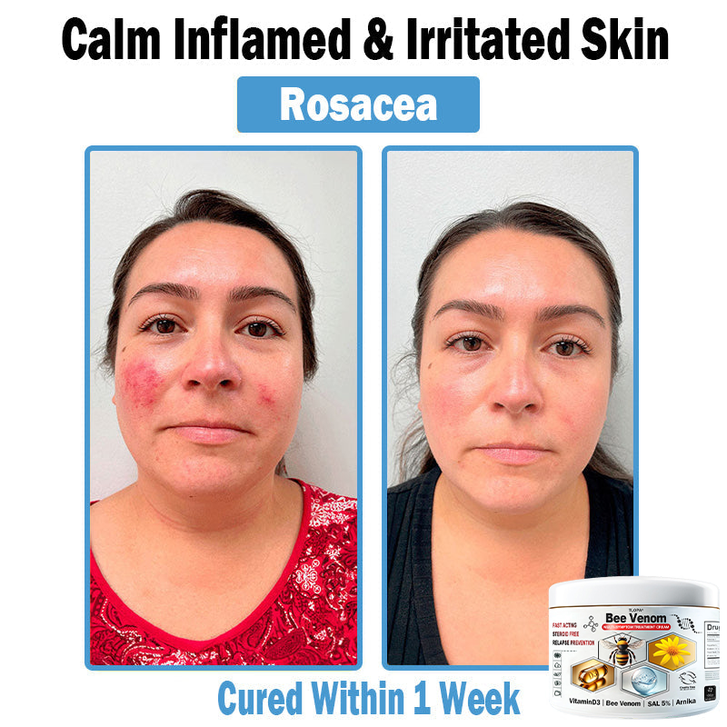 TLOPA® Bee Venom Multi-Symptom Skin Treatment Cream (👨‍⚕🌟Extra 30% off on sale items!