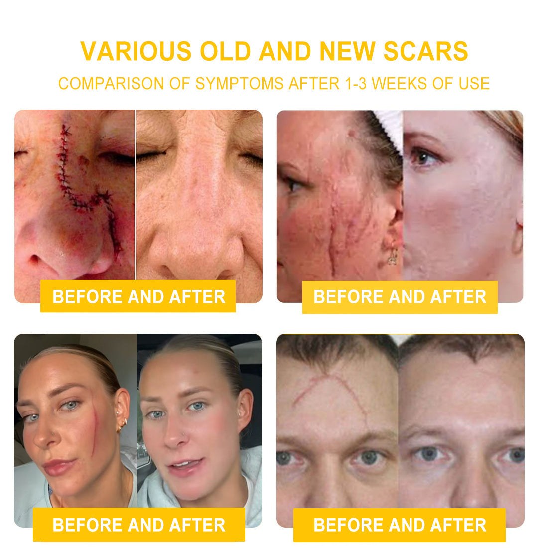 TLOPA® Bee Venom Skin Cream（👨‍⚕AAD Recommended),for Remove Warts, Acne and Scars ✅
