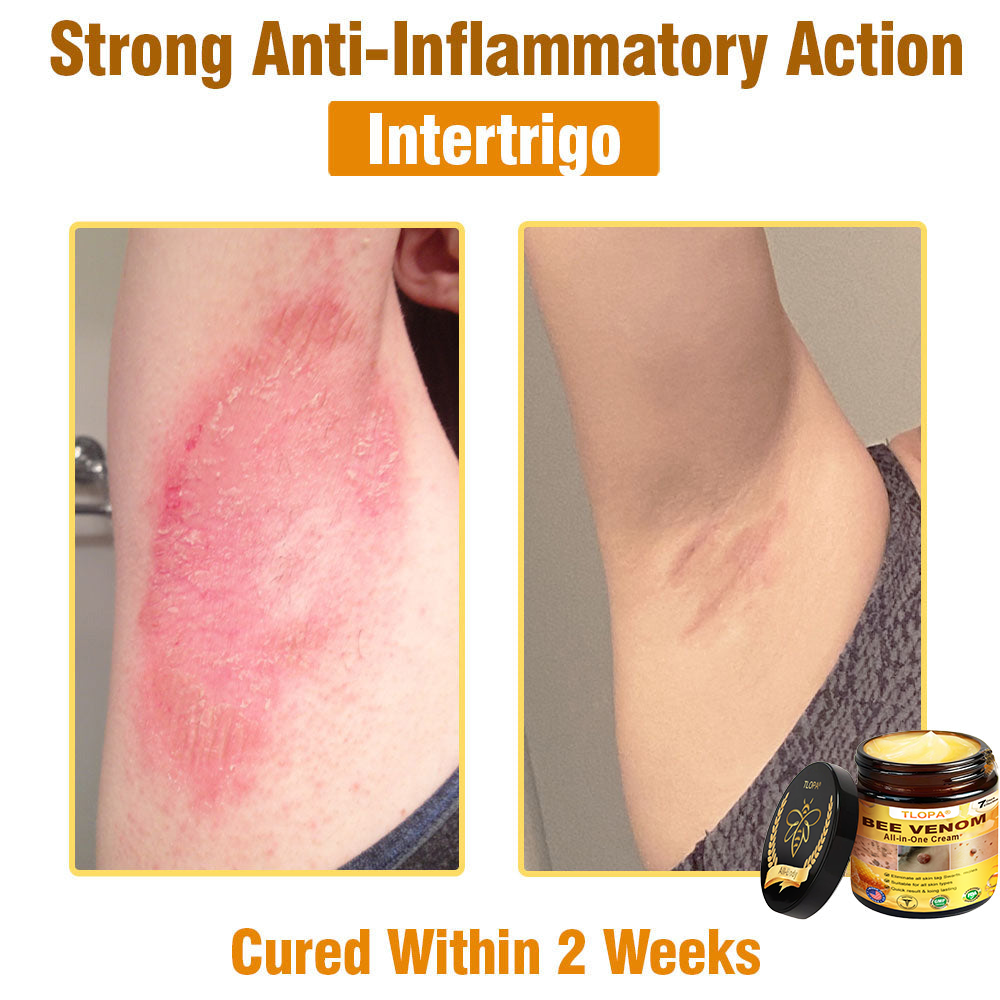 TLOPA® Bee Venom All-in-One Cream US Dermatologist Approved