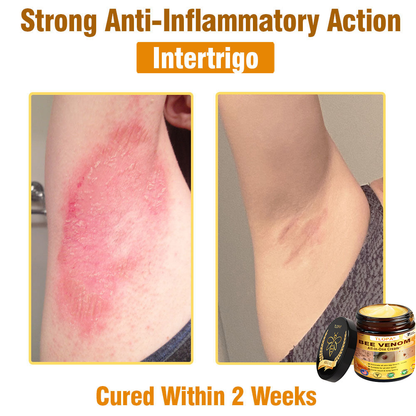 TLOPA® Bee Venom All-in-One Cream US Dermatologist Approved