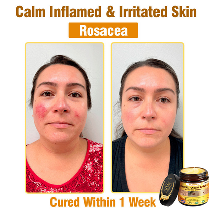 TLOPA® Bee Venom All-in-One Cream US Dermatologist Approved